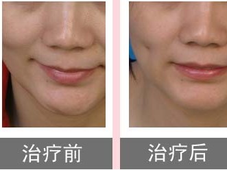酒窩成形后會(huì)有面癱的風(fēng)險(xiǎn)嗎