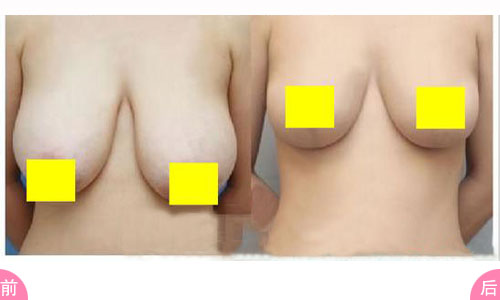 <a href=http://www.sbs17.com/listinfo-617-0.html target=_blank class=infotextkey>巨乳縮小</a>術(shù)的方法有那些