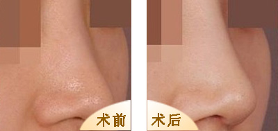 自體脂肪<a href=http://www.sbs17.com/listinfo-737-0.html target=_blank class=infotextkey>隆鼻</a>的優(yōu)缺點(diǎn)