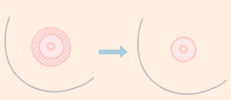貴州乳暈<a href=http://www.sbs17.com/listinfo-615-0.html target=_blank class=infotextkey>胸部整形</a>手術(shù)安全嗎