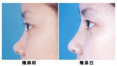 武漢<a href=http://www.sbs17.com/listinfo-737-0.html target=_blank class=infotextkey>隆鼻</a>修復(fù)手術(shù)的價格