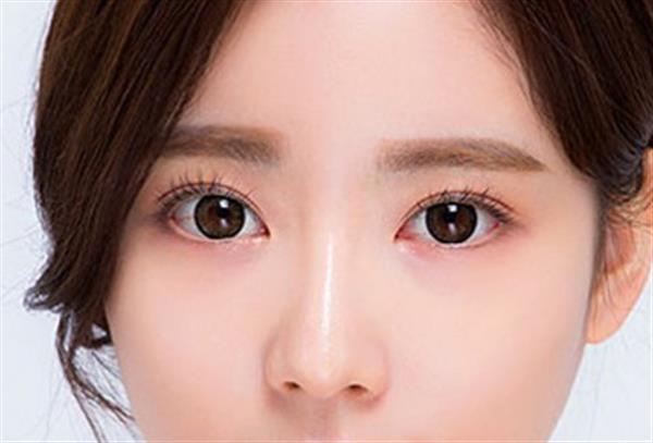 微創(chuàng)<a href=http://www.sbs17.com/listinfo-724-0.html target=_blank class=infotextkey>雙眼皮</a>怎樣恢復(fù)快