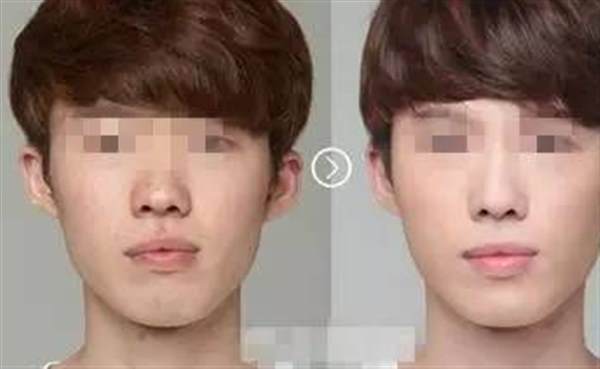 男人也可以做<a href=http://www.sbs17.com/listinfo-737-0.html target=_blank class=infotextkey>隆鼻</a>手術(shù)