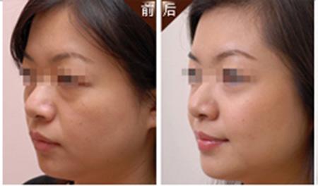 自體脂肪<a href=http://www.sbs17.com/listinfo-614-0.html target=_blank class=infotextkey>除皺</a>特點(diǎn)
