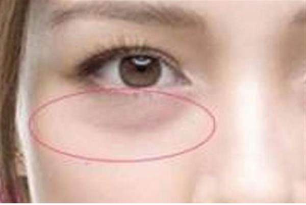 熱效<a href=http://www.sbs17.com/listinfo-682-0.html target=_blank class=infotextkey>溶脂</a><a href=http://www.sbs17.com/listinfo-708-0.html target=_blank class=infotextkey>去眼袋</a>的缺點有什么