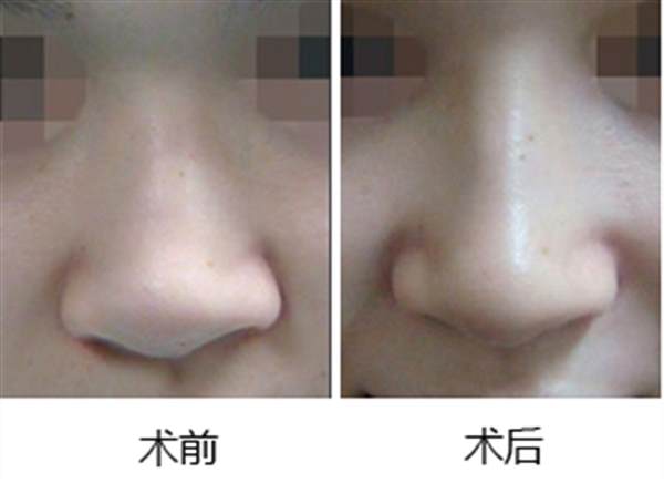 <a href=http://www.sbs17.com/listinfo-737-0.html target=_blank class=infotextkey>隆鼻</a>術注意事項