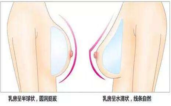 妙桃晴面假體<a href=http://www.sbs17.com/listinfo-618-0.html target=_blank class=infotextkey>隆胸</a>的4大特點(diǎn)