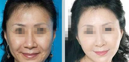 拉皮后頭套要戴多久