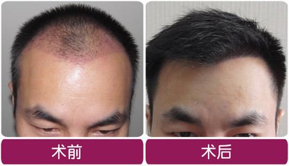 做植發(fā)手術(shù)要多少錢(qián)
