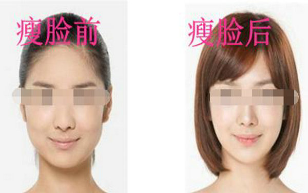 磨骨<a href=http://www.sbs17.com/listinfo-631-0.html target=_blank class=infotextkey>瘦臉</a>危險嗎?
