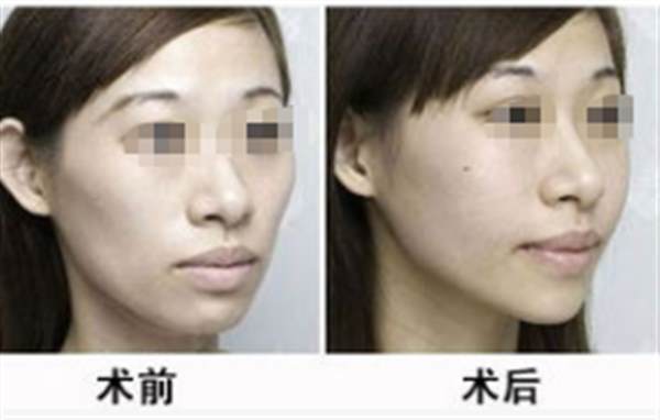 磨顴骨恢復(fù)期多久?