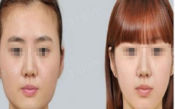磨顴骨手術(shù)要多少錢?