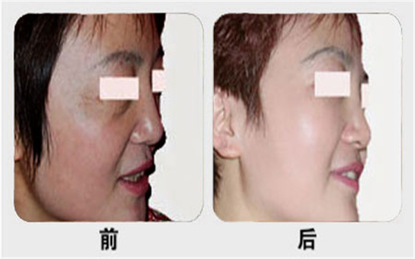 opt光子<a href=http://www.sbs17.com/listinfo-770-0.html target=_blank class=infotextkey>嫩膚</a>的費用