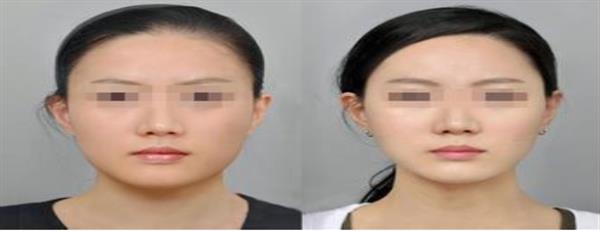 打<a href=http://www.sbs17.com/listinfo-631-0.html target=_blank class=infotextkey>瘦臉</a><a href=http://www.sbs17.com/listinfo-614-0.html target=_blank class=infotextkey>除皺</a>注意事項(xiàng)