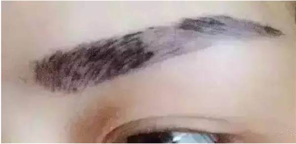 紋眉后幾天掉痂