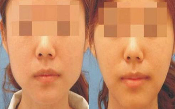 磨下顎骨恢復(fù)期多久?
