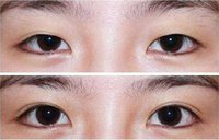 有關(guān)切開<a href=http://www.sbs17.com/listinfo-724-0.html target=_blank class=infotextkey>雙眼皮</a>的術(shù)前準(zhǔn)備