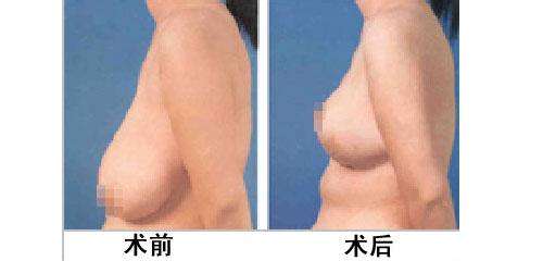未婚乳房下垂的常見矯正方法