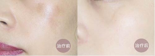 opt光子<a href=http://www.sbs17.com/listinfo-770-0.html target=_blank class=infotextkey>嫩膚</a>原理