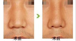 <a href=http://www.sbs17.com/listinfo-751-0.html target=_blank class=infotextkey>歪鼻矯正</a>手術(shù)的適應(yīng)和禁忌癥