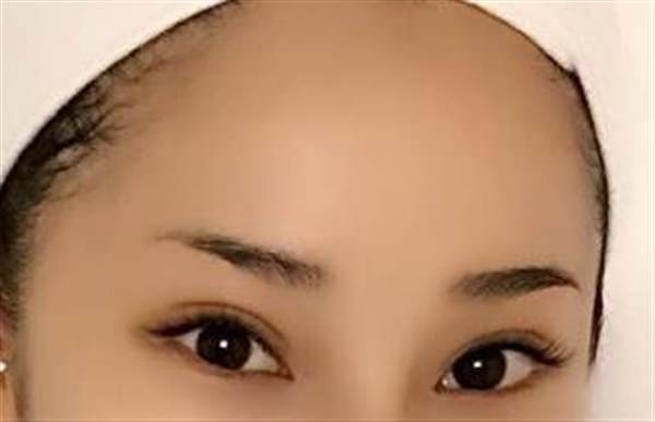 額頭脂肪填充的后遺癥