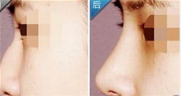 硅膠<a href=http://www.sbs17.com/listinfo-737-0.html target=_blank class=infotextkey>隆鼻</a>排異哪些特點(diǎn)