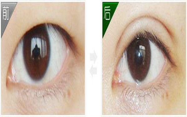 哪個季節(jié)割<a href=http://www.sbs17.com/listinfo-724-0.html target=_blank class=infotextkey>雙眼皮</a>較好?