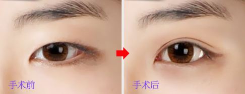 <a href=http://www.sbs17.com/listinfo-724-0.html target=_blank class=infotextkey>雙眼皮</a>埋線法可保幾年