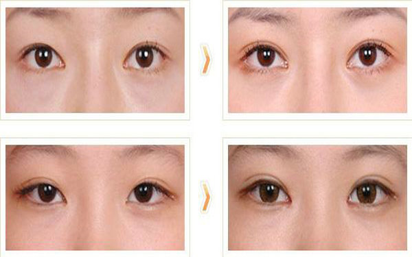 哪些人不適合做<a href=http://www.sbs17.com/listinfo-724-0.html target=_blank class=infotextkey>雙眼皮</a>?