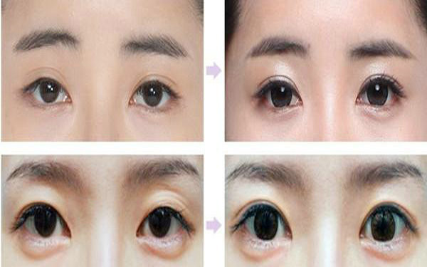納米<a href=http://www.sbs17.com/listinfo-724-0.html target=_blank class=infotextkey>雙眼皮</a>多久能化妝?