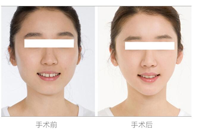 硅膠墊價格