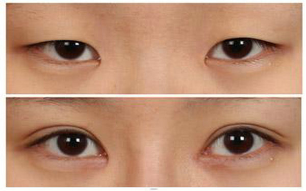 納米<a href=http://www.sbs17.com/listinfo-724-0.html target=_blank class=infotextkey>雙眼皮</a>是不是長(zhǎng)久的?