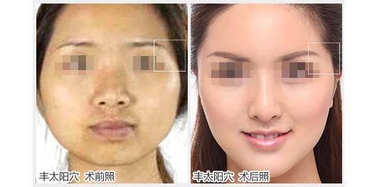 透明質(zhì)酸豐太陽(yáng)的并發(fā)癥有哪些