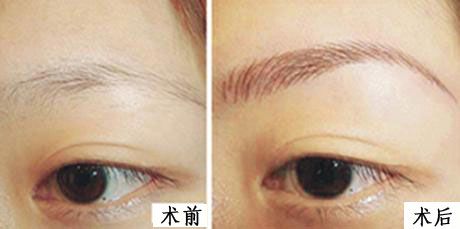 豐眉弓要多少錢