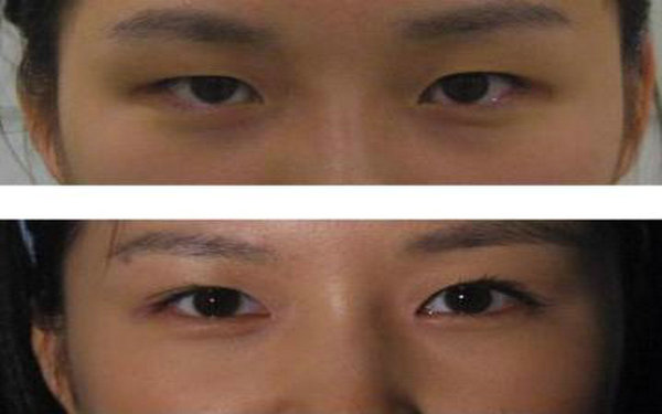 納米無(wú)痕好還是埋線(xiàn)好?