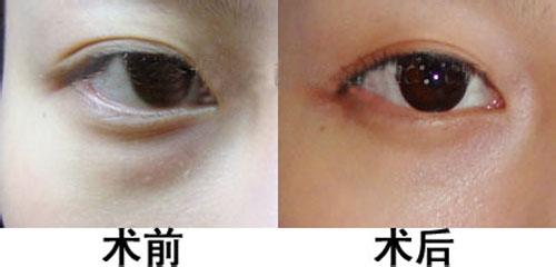 內(nèi)切眼袋副作用
