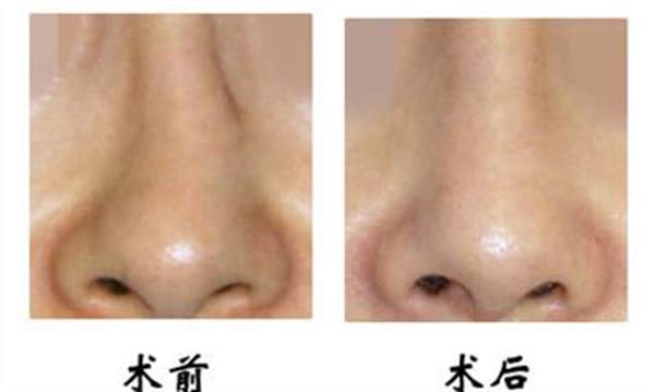 <a href=http://www.sbs17.com/listinfo-751-0.html target=_blank class=infotextkey>歪鼻矯正</a>手術(shù)的后遺癥及禁忌