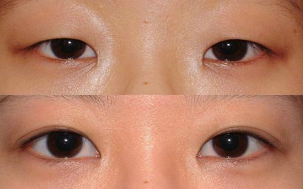 納米無(wú)痕和埋線的區(qū)別?