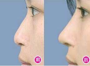 南京墊鼻子價(jià)格是多少