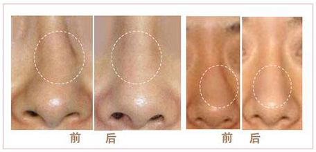  假體<a href=http://www.sbs17.com/listinfo-737-0.html target=_blank class=infotextkey>隆鼻</a>慢性排異反應