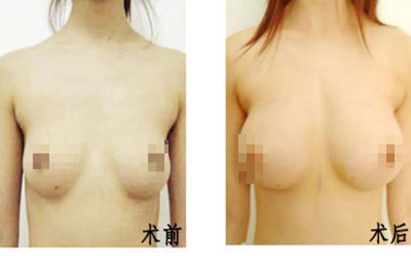 哪種豐胸手術(shù)較好？