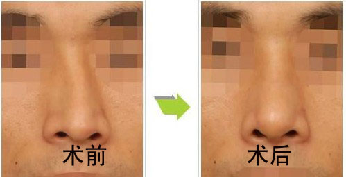 歪鼻整形手術(shù)的注意事項(xiàng)