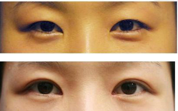 納米無痕<a href=http://www.sbs17.com/listinfo-724-0.html target=_blank class=infotextkey>雙眼皮</a>的危害?