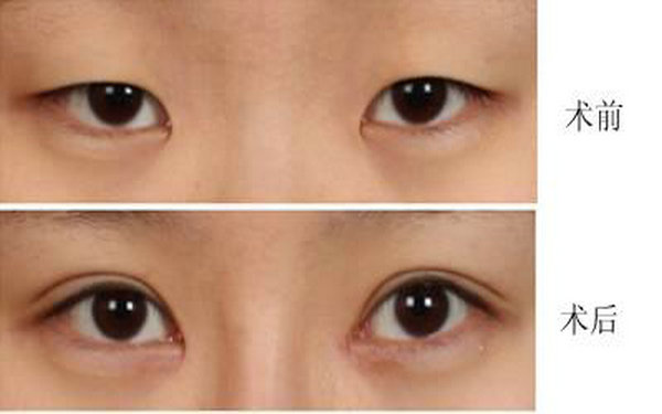納米無痕<a href=http://www.sbs17.com/listinfo-724-0.html target=_blank class=infotextkey>雙眼皮</a>禁忌?
