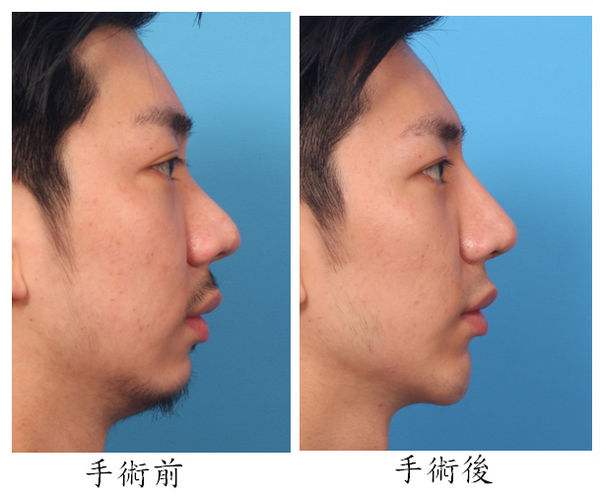墊下巴和<a href=http://www.sbs17.com/listinfo-737-0.html target=_blank class=infotextkey>隆鼻</a>哪個痛苦
