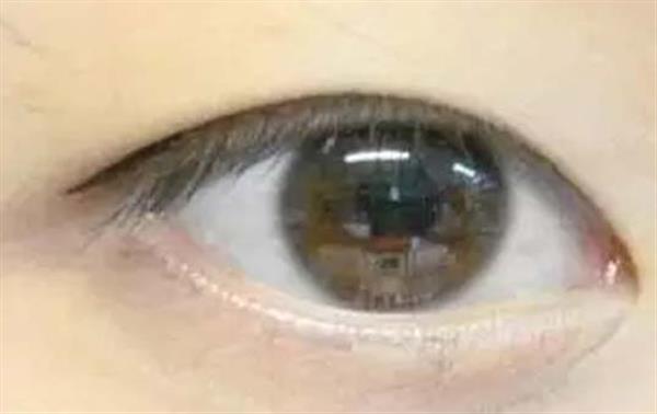 內(nèi)切眼袋手術(shù)后的恢復(fù)期