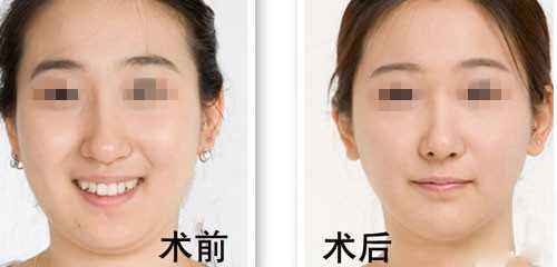 怎樣減<a href=http://www.sbs17.com/listinfo-638-0.html target=_blank class=infotextkey>去雙下巴</a>
