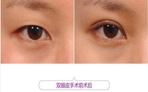 切開(kāi)<a href=http://www.sbs17.com/listinfo-724-0.html target=_blank class=infotextkey>雙眼皮</a>幾天拆線?