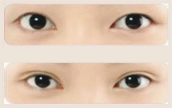 切<a href=http://www.sbs17.com/listinfo-724-0.html target=_blank class=infotextkey>雙眼皮</a>恢復(fù)時(shí)間