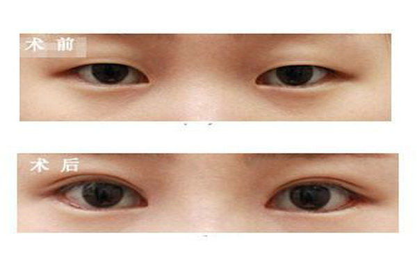 切<a href=http://www.sbs17.com/listinfo-724-0.html target=_blank class=infotextkey>雙眼皮</a>會留疤痕嗎